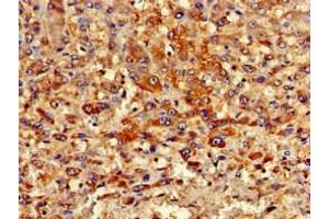 Immunohistochemistry of paraffin-embedded human liver cancer using ABIN7162982 at dilution of 1:100 (PIPOX Antikörper  (AA 259-337))