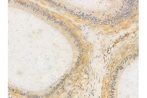 ABIN6265066 and ABIN6266633 at 1/100 staining human testicular cancer by IHC-P. (INPP5D Antikörper  (C-Term))