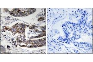Immunohistochemistry analysis of paraffin-embedded human breast carcinoma, using Girdin (Phospho-Ser1417) Antibody.