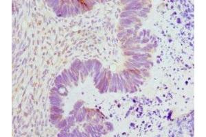 Immunohistochemistry of paraffin-embedded human ovarian cancer using ABIN7151362 at dilution of 1:100 (ENOX2 Antikörper  (AA 411-610))