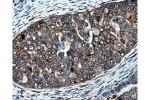 Immunohistochemical staining of paraffin-embedded Adenocarcinoma of colon tissue using anti-IFT57mouse monoclonal antibody. (IFT57 Antikörper)