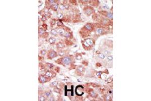 Formalin-fixed and paraffin-embedded human hepatocellular carcinoma tissue reacted with GRK7 polyclonal antibody  , which was peroxidase-conjugated to the secondary antibody, followed by AEC staining. (GRK7 Antikörper  (C-Term))