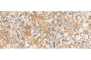 Immunohistochemistry of paraffin-embedded Human liver cancer tissue using ANXA13 Polyclonal Antibody at dilution of 1:105(x200) (Annexin A13 Antikörper)
