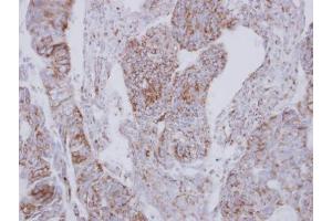 IHC-P Image Immunohistochemical analysis of paraffin-embedded human colon carcinoma, using NDUFS2, antibody at 1:250 dilution.