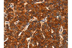 The image on the left is immunohistochemistry of paraffin-embedded Human liver cancer tissue using ABIN7190469(DHH Antibody) at dilution 1/25, on the right is treated with synthetic peptide. (desert Hedgehog Antikörper)
