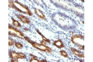 Formalin-fixed, paraffin-embedded human gastric carcinoma stained with Mucin-6 antibody (MUC6/916). (MUC6 Antikörper)