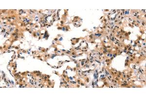 Immunohistochemistry of paraffin-embedded Human thyroid cancer tissue using CUL4B Polyclonal Antibody at dilution 1:50 (Cullin 4B Antikörper)