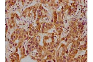 IHC image of ABIN7146186 diluted at 1:300 and staining in paraffin-embedded human liver cancer performed on a Leica BondTM system. (CELSR3 Antikörper  (AA 514-718))