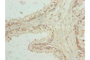 Immunohistochemistry of paraffin-embedded human prostate cancer using ABIN7168900 at dilution of 1:100 (SPTLC3 Antikörper  (AA 1-58))