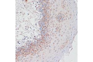 Immunohistochemistry of paraffin-embedded Human tonsil using Desmoplakin antibody (ABIN6134106, ABIN6139838, ABIN6139840 and ABIN6223548) at dilution of 1:100 (40x lens).