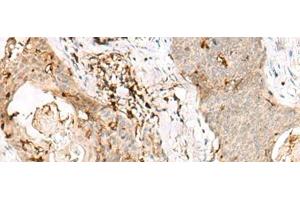 Immunohistochemistry of paraffin-embedded Human esophagus cancer tissue using OVOL2 Polyclonal Antibody at dilution of 1:50(x200) (OVOL2 Antikörper)