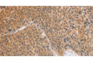 Immunohistochemistry of paraffin-embedded Human liver cancer using BRS3 Polyclonal Antibody at dilution of 1:50 (BRS3 Antikörper)