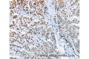 Immunohistochemistry of Human prostate cancer using ELAVL1 Polyclonal Antibody at dilution of 1:50 (ELAVL1 Antikörper)