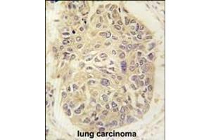 Formalin-fixed and paraffin-embedded human lung carcinoma tissue reacted with FARSA antibody (N-term) (ABIN391817 and ABIN2841665) , which was peroxidase-conjugated to the secondary antibody, followed by DAB staining. (Phenylalanyl-tRNA Synthetase, alpha Subunit (FARSA) (AA 54-83), (N-Term) Antikörper)
