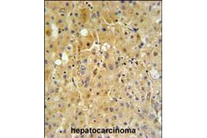 P450R Antibody IHC analysis in formalin fixed and paraffin embedded human hepatocarcinoma tissue followed by peroxidase conjugation of the secondary antibody and DAB staining.