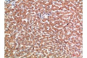 Immunohistochemical analysis of paraffin-embedded human-liver-cancer, antibody was diluted at 1:200 (CD137 Antikörper  (AA 111-160))