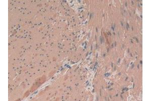 IHC-P analysis of Human Rectum Cancer Tissue, with DAB staining. (Smooth Muscle Actin Antikörper  (AA 167-377))