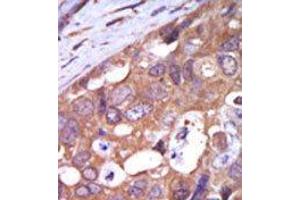 Formalin-fixed and paraffin-embedded human cancer tissue reacted with the primary antibody, which was peroxidase-conjugated to the secondary antibody, followed by AEC staining. (PKC mu Antikörper  (N-Term))
