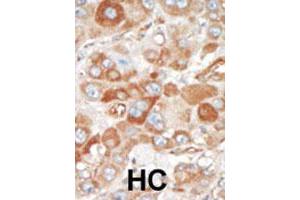 Formalin-fixed and paraffin-embedded human hepatocellular carcinoma tissue reacted with SRPK2 polyclonal antibody  , which was peroxidase-conjugated to the secondary antibody, followed by DAB staining. (SRPK2 Antikörper  (C-Term))