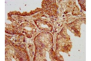 IHC image of ABIN7175101 diluted at 1:200 and staining in paraffin-embedded human prostate cancer performed on a Leica BondTM system. (SLC14A1 Antikörper  (AA 1-51))