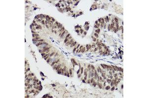 Immunohistochemistry of paraffin-embedded human lung cancer using ST Rabbit pAb (ABIN3020614, ABIN3020615, ABIN3020616 and ABIN6213588) at dilution of 1:50 (40x lens). (STAT1 Antikörper  (AA 513-712))