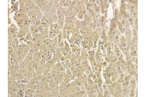 at 1/100 staining human hepatocellular carcinoma by IHC-P. (HCLS1 Antikörper  (Internal Region))