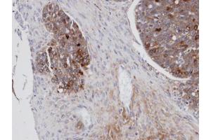 IHC-P Image Immunohistochemical analysis of paraffin-embedded human serous ovarian cancer, using MSLN, antibody at 1:100 dilution. (Mesothelin Antikörper)