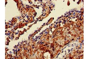 Immunohistochemistry of paraffin-embedded human lung cancer using ABIN7152377 at dilution of 1:100 (CAPZA2 Antikörper  (AA 2-286))