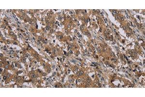 Immunohistochemistry of paraffin-embedded Human liver cancer tissue using MAL Polyclonal Antibody at dilution 1:30 (MAL Antikörper)