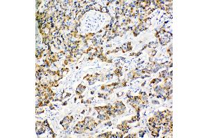 Anti-Peroxiredoxin 3 antibody, IHC(P) IHC(P): Human Mammary Cancer Tissue (Peroxiredoxin 3 Antikörper  (C-Term))