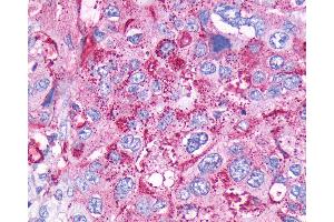 Anti-CCKBR / Cckb antibody IHC of human Pancreas, Carcinoma. (CCKBR Antikörper  (Cytoplasmic Domain))