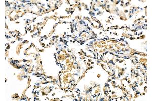 ABIN6263447 and ABIN6278081 at 1/100 staining Human lung cancer and adjacent non-tumor tissue by IHC-P. (MXD3 Antikörper  (Internal Region))