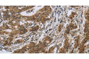 Immunohistochemistry of paraffin-embedded Human gastric cancer using IL5RA Polyclonal Antibody at dilution of 1:40 (IL5RA Antikörper)