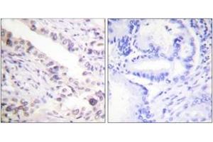 Immunohistochemistry analysis of paraffin-embedded human prostate carcinoma tissue, using Smad2 (Ab-467) Antibody. (SMAD2 Antikörper  (AA 418-467))