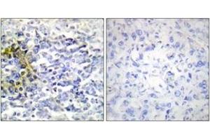 Immunohistochemistry analysis of paraffin-embedded human lung carcinoma tissue, using FXR2 Antibody. (FXR2 Antikörper  (AA 551-600))