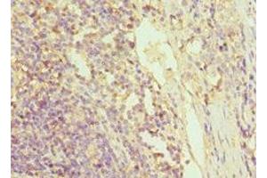 Immunohistochemistry of paraffin-embedded human colon cancer using ABIN7154393 at dilution of 1:100 (Granulin Antikörper  (AA 20-310))