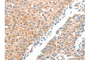 The image on the left is immunohistochemistry of paraffin-embedded Human breast cancer tissue using ABIN7128229(ADAM2 Antibody) at dilution 1/20, on the right is treated with fusion protein. (ADAM2 Antikörper)