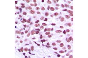 Immunohistochemical analysis of MZF1 staining in human breast cancer formalin fixed paraffin embedded tissue section.