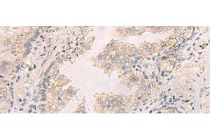 Immunohistochemistry of paraffin-embedded Human prost at e cancer tissue using TNNT1 Polyclonal Antibody at dilution of 1:35(x200) (TNNT1 Antikörper)