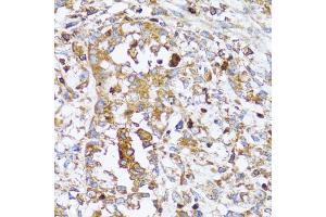 Immunohistochemistry of paraffin-embedded human uterine cancer using ACTR2 antibody (ABIN5973361) at dilution of 1/100 (40x lens). (ACTR2 Antikörper)