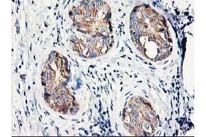 Immunohistochemical staining of paraffin-embedded Adenocarcinoma of Human breast tissue using anti-EIF2B3 mouse monoclonal antibody.