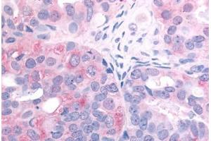 Human Ovarian Carcinoma (formalin-fixed, paraffin-embedded) stained with EGFR antibody ABIN213615 at 2. (EGFR Antikörper  (C-Term))