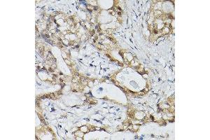 Immunohistochemistry of paraffin-embedded human lung cancer using ESE1/ELF3 Rabbit pAb (ABIN6130347, ABIN6140125, ABIN6140127 and ABIN6221990) at dilution of 1:150 (40x lens). (ELF3 Antikörper  (AA 1-280))