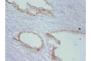 Immunohistochemistry of paraffin-embedded human prostate cancer using ABIN7172200 at dilution of 1:100 (TIMP1 Antikörper)
