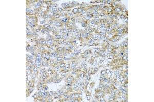 Immunohistochemistry of paraffin-embedded human liver cancer using NDUFA2 antibody at dilution of 1:100 (x40 lens). (NDUFA2 Antikörper)