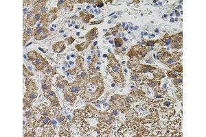 Immunohistochemistry of paraffin-embedded Human liver damage using NTF3 Polyclonal Antibody (Neurotrophin 3 Antikörper)