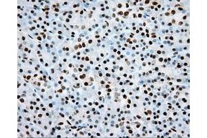 Immunohistochemical staining of paraffin-embedded Adenocarcinoma of colon tissue using anti-ARNT mouse monoclonal antibody. (ARNT Antikörper)