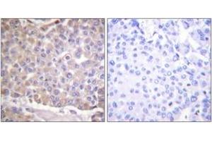 Immunohistochemistry analysis of paraffin-embedded human breast carcinoma tissue, using IRS-1 (Ab-1101) Antibody. (IRS1 Antikörper  (AA 1067-1116))