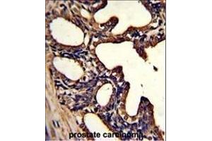 Formalin-fixed and paraffin-embedded human prostate carcinoma with LTF Monoclonal Antibody, which was peroxidase-conjugated to the secondary antibody, followed by DAB staining. (Lactoferrin Antikörper)