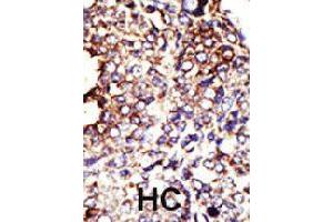 Formalin-fixed and paraffin-embedded human hepatocellular carcinoma tissue reacted with GCNT1 polyclonal antibody  , which was peroxidase-conjugated to the secondary antibody, followed by DAB staining . (GCNT1 Antikörper  (Internal Region))